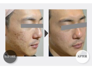 マリス(MARISS)/クリスタルパックB&A <シミ改善>