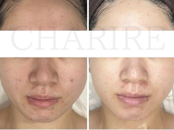 シェリル 松江店(CHARIRE)/ハーブピーリング/フェイシャル