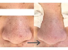 モネ(monet)/韓国式3D毛穴洗浄