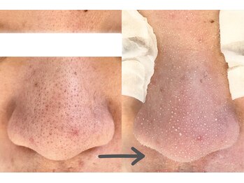 モネ(monet)/韓国式3D毛穴洗浄