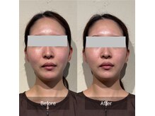 菫鍼灸院の雰囲気(頭皮鍼付き全顔美容鍼で、左右差やたるみを改善します)