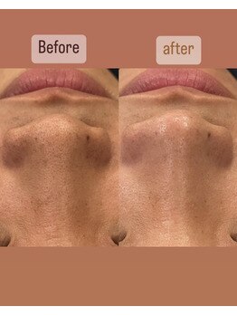 カエデ(Kaede)/【毛穴洗浄ビフォアフ】