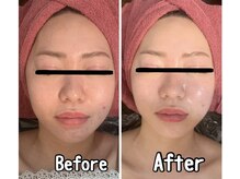 ブランシュール/小顔タイト×エンビロン