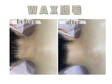 レヴィート(Revept)/【ワックス脱毛】