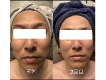 プライム(Prime)/ハーブピーリング