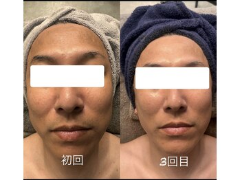 プライム(Prime)/ハーブピーリング