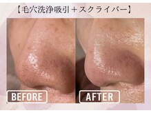 オキシー グレイス 小倉店(OXY Grace)/【毛穴洗浄】