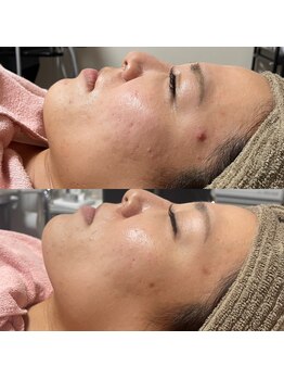 ティグレ 岡山店(TIGRE)/光フェイシャル(しみ予防)