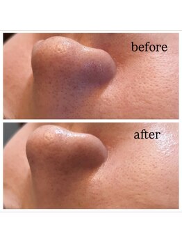 リエイト(Re:eight)/ハイドラ+ハーブピーリング