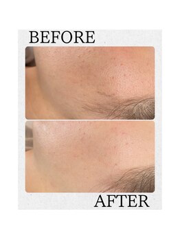 ブリス(BLISS.)/お顔そり後のビフォーアフター