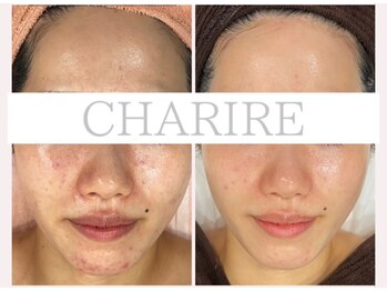 シェリル 松江店(CHARIRE)/ハーブピーリング/フェイシャル