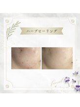 アディッシモ(addissimo)/気になる跡や赤みにも☆