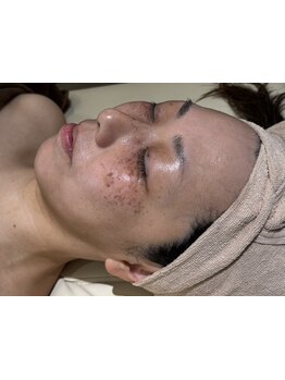 シミしわ改善！予防ケア