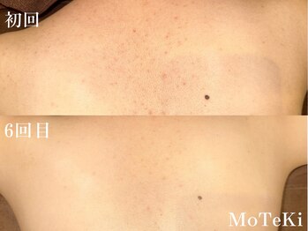 モテキ 表参道店(MoTeKi)/症例Befor/After背中肌荒れ