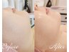 OPEN価格★【小顔・たるみケア】EMSリフトアップフェイシャル¥12000→¥4980