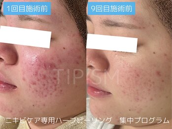 アクネラボ 梅田店(ACNE LABO)/ニキビは卒業できるんです！！