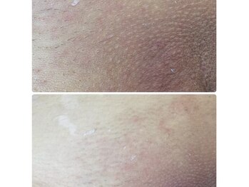 リセラージュ(Recellage)/黒ずみハリたるみ見た目ケア◎