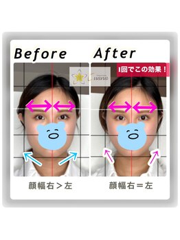 ルアナ(Luana)/最新ウルトラ小顔リフト