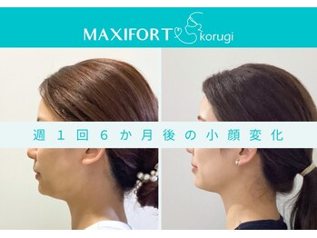 マキシフォート 名駅店(Maxifort)/週1回6ヶ月後の小顔変化