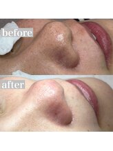 ライカブルー(RaicA BluE)/施術写真　before-after