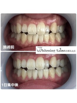 ホワイトニングサロン 京都烏丸店/ホワイトニング施術例