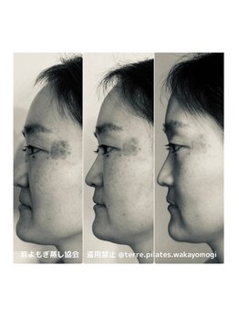 リリィ(RIRY)/【よもぎ蒸し】ビフォーアフター