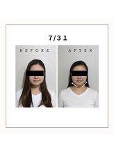 ミヤビ(miyabi)/小顔矯正