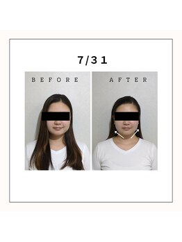 ミヤビ(miyabi)/小顔矯正