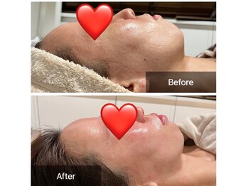 サロンツキ(salon tuki)/【幹細胞ピーリング】症例★