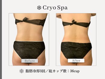 クリオスパ せんげん台駅前店(Cryo Spa)/脂肪冷却