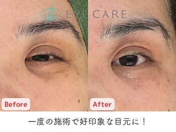 アイケアー(EYE CARE)/針も切りもせずこの変化
