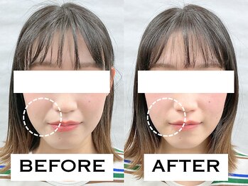 ビハリスト 新宿南口/ほうれい線の改善に自信アリ！