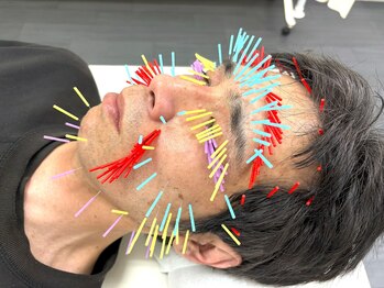 とだ鍼灸院/《立体的な小顔◎美容鍼 200本》