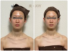 美 ジョイ(美 JOY)/小顔コルギ　施術例