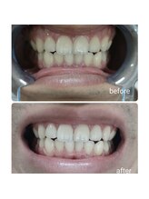 エクシアホワイトニング エミフルMASAKI店/ホワイトニングビフォーアフター