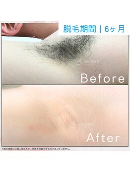 メンズクリア 上水戸ドンキ店/【メンズクリア】お客様の施術例