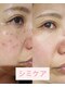 ウズラ(UZURA)の写真/濃く浮き出たシミに本気ケア！大人世代のための集中改善ピンポイントで気になる箇所にアプローチ♪