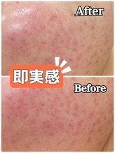 エピ エピ プラス イオンモール宇城店(EPI*EPI+)/光フェイシャル Before→After