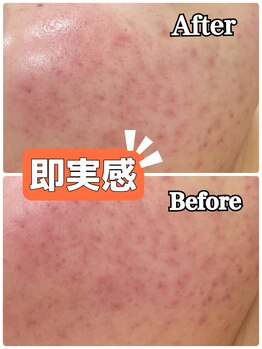 エピ エピ プラス イオンモール宇城店(EPI*EPI+)/光フェイシャル Before→After