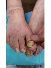 フットケアサロン ラビフット(Rabbi foot)/肥厚爪は早目のケアを