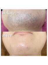 ヴァーチュ(Virtue)/髭脱毛