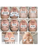 チュルリ 新町店(Chururi)/小顔/リフトアップ