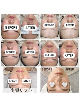 チュルリ 新町店(Chururi)/小顔/リフトアップ