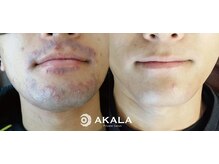 メンズ脱毛サロン アカラ(AKALA)/肌荒れ改善メンズヒゲ脱毛