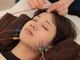 リニューサロン 本院(renew salon)の写真/【肌の内側からケアする美容鍼】お顔の悩み、解消したいあなたにおすすめ☆くすみやたるみを改善◎