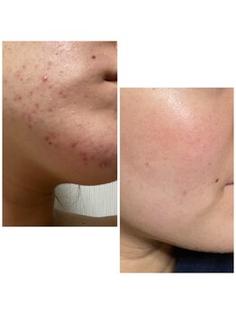 ベルダ(Beldad)/ニキビケア・敏感肌ケアも得意☆