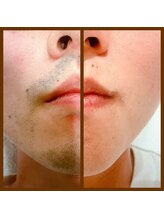 リアンジュ/ヒゲ脱毛の経過