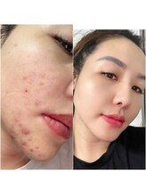 エミリー(Emily)/ニキビケア