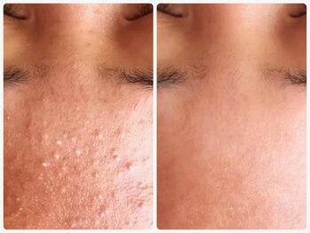 ルクシア(RUXCIA)/ビフォーアフターピーリング20回