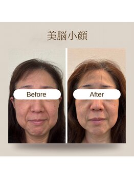アネラ(ANERA)/小顔矯正&毛穴洗浄BeforeAfter